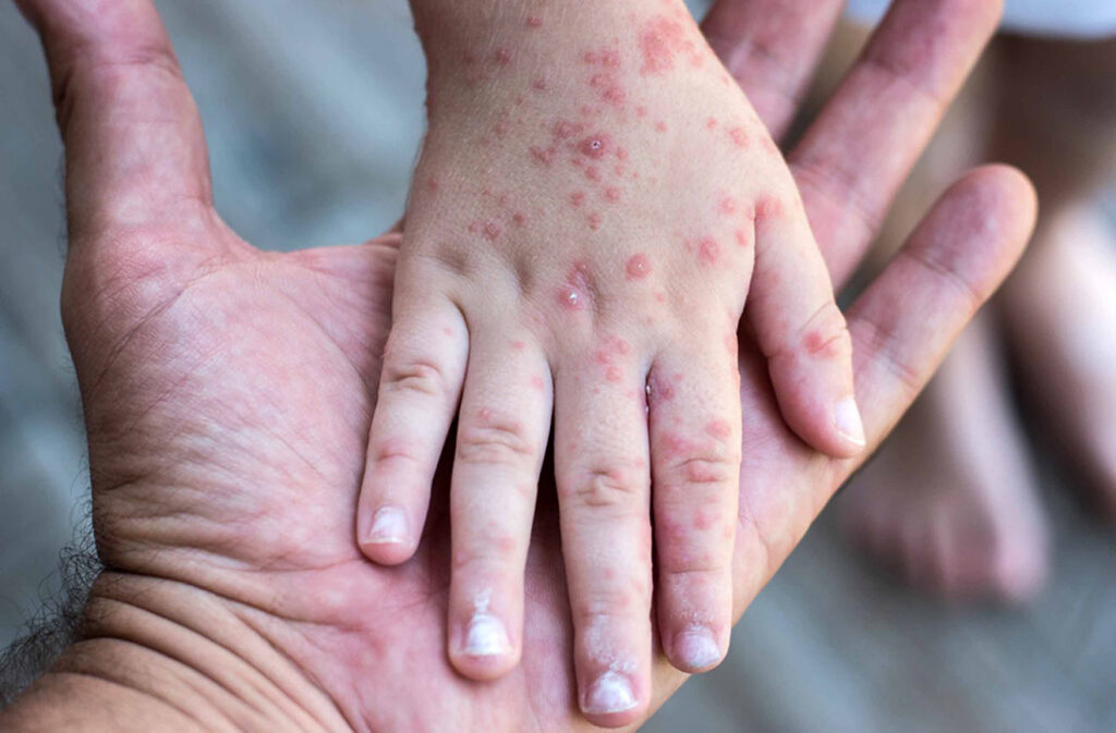 Confirman 21 casos de sarampión en Tabasco