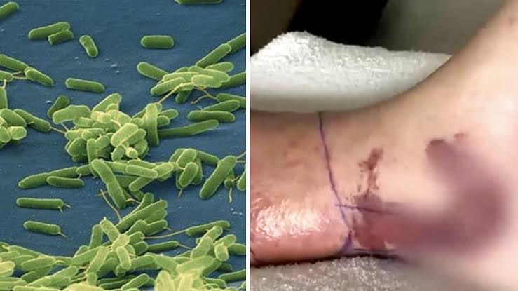 Florida confirma la primera muerte de 2026 en EU por la bacteria carnívora Vibrio vulnificus